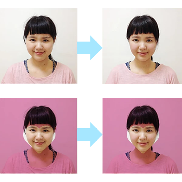 施術例：小顔矯正