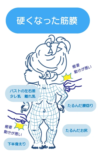 筋膜（ファシア）のねじれと癒着の図解｜筋肉を締め付け、むくみやたるみといった外見の崩れを引き起こす筋膜のシワの状態